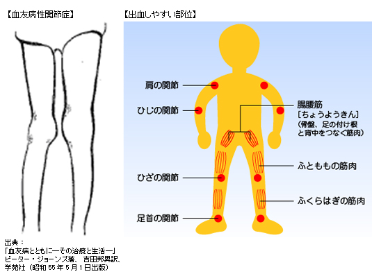 血友病性関節症、出血しやすい部位 血友病性関節症、出血しやすい部位