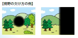 視神経炎の症例写真2