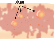 炎症型の皮疹