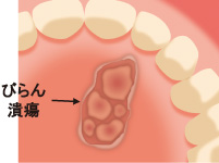 口内炎の例