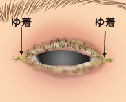 目のびらんの例