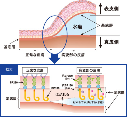 自己抗体のイメージ